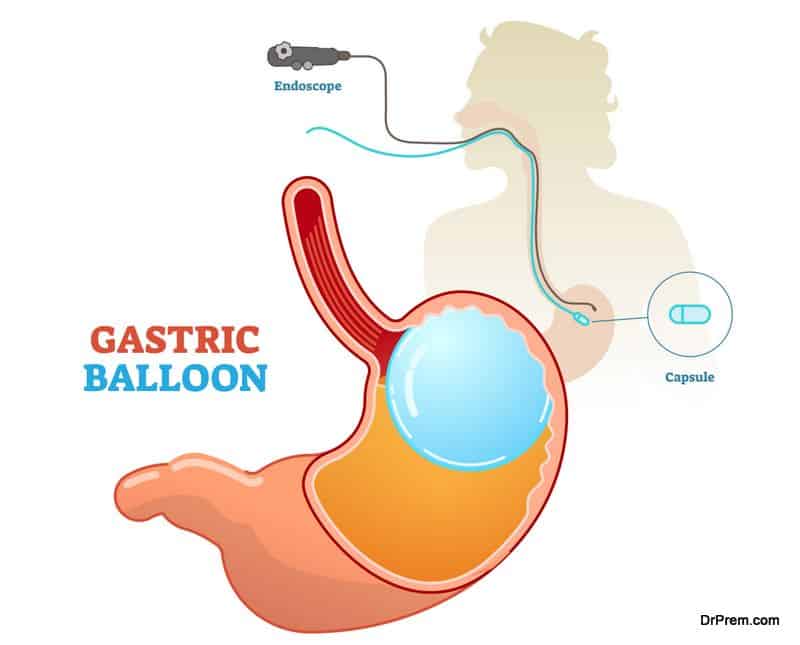 Gastric balloon medical procedure 