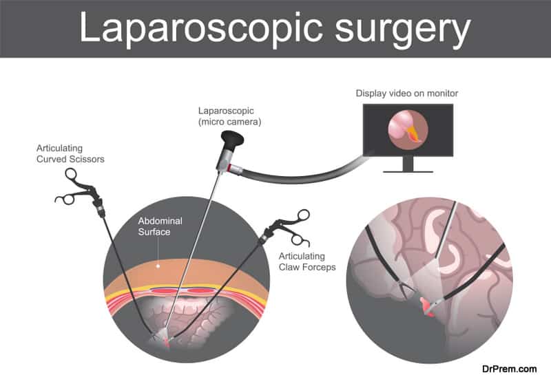 Laparoscopic surgery