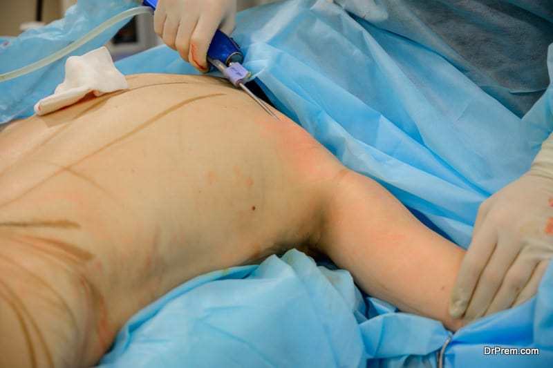 Pumping out subcutaneous fat in the operating room