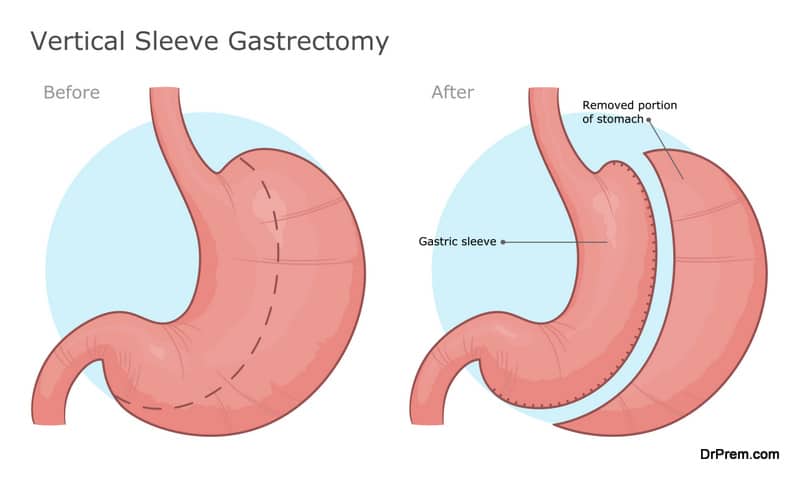 Sleeve Gastrectomy