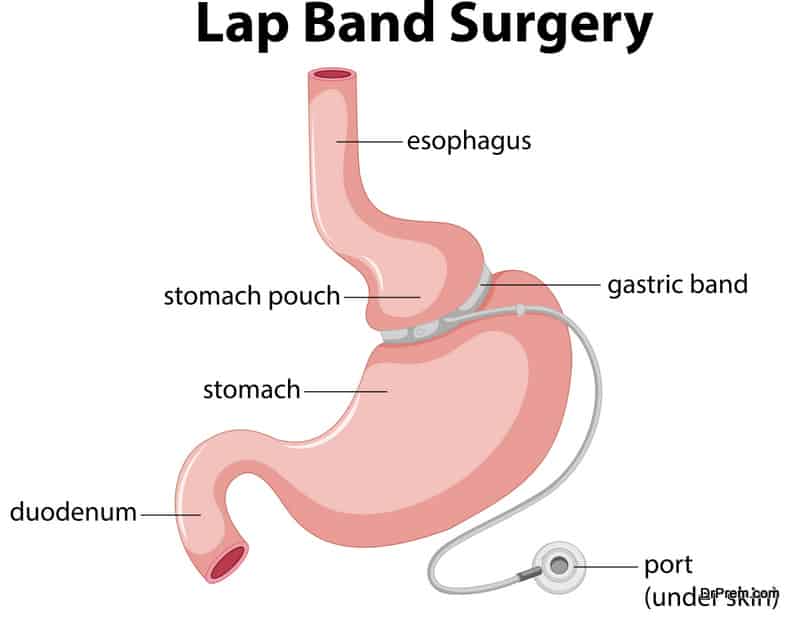 advanced lap band surgery