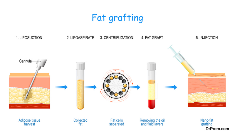 Fat grafting