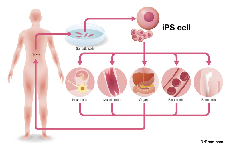 Induced pluripotent stem cell (iPS cell) and regenerative medicine