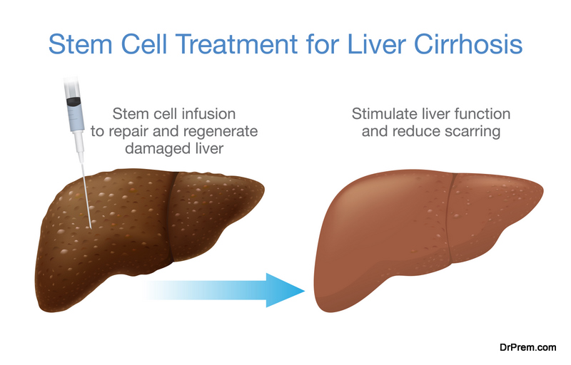 Stem Cell treatment for Liver Cirrhosis