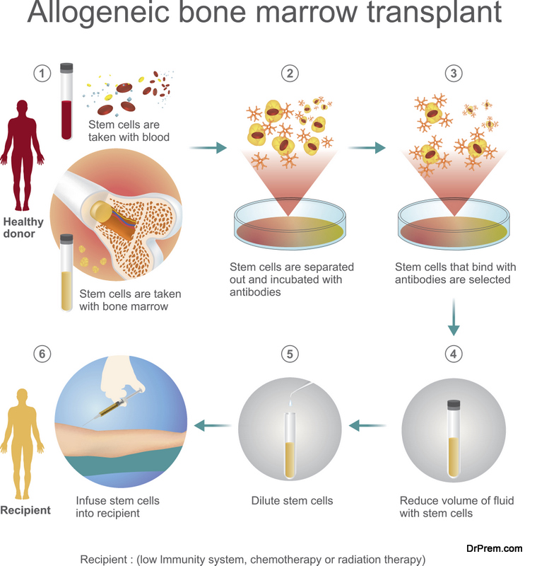 The allogeneic transplant process are donated to the person from another person, a genetically matched stem cell donor. Info graphic vector.