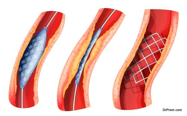 Stent used to open blocked artery