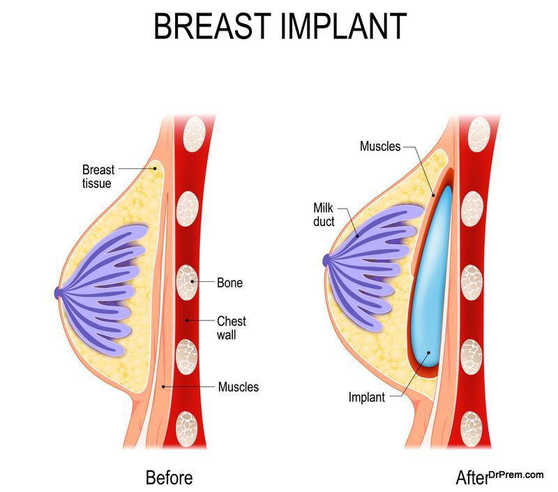 Breast Implant