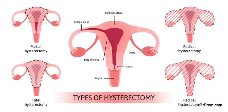 Hysterectomy