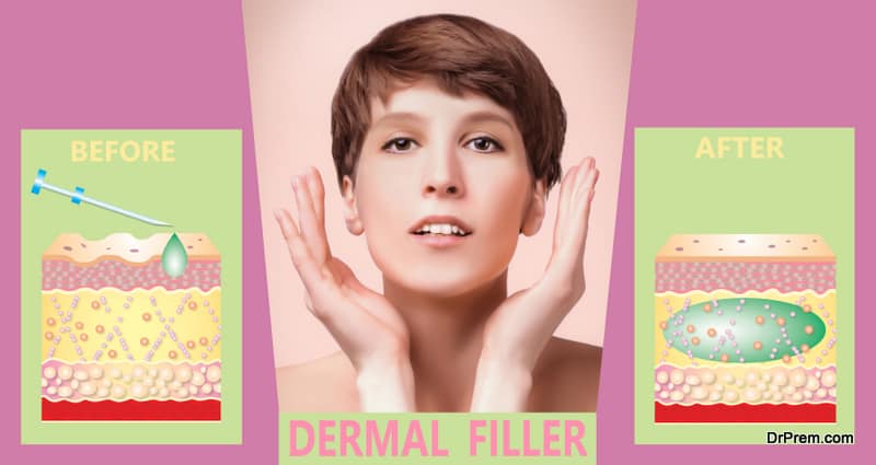 dermal fillers