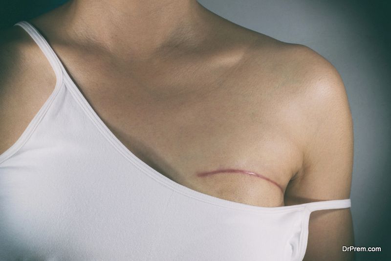 mastectomy