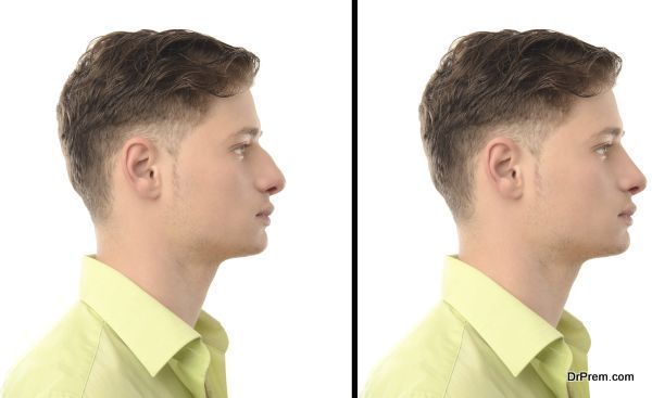 rhinoplasty