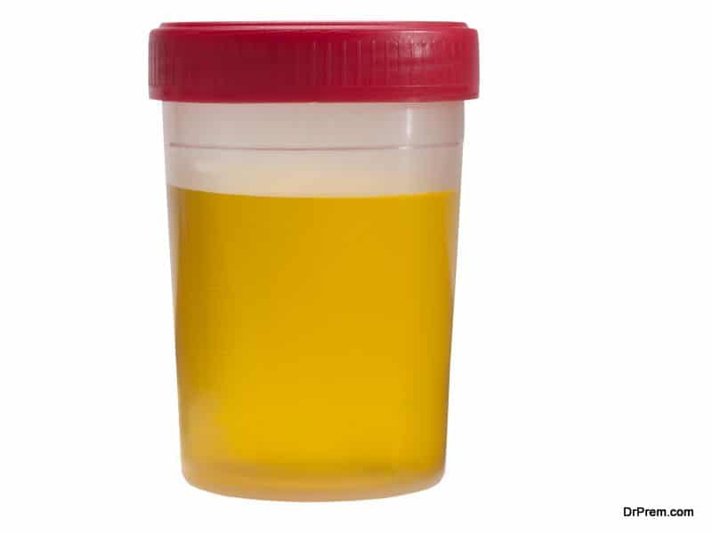 urine-analysis