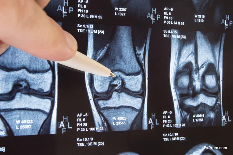 Knee-Replacement-Implant