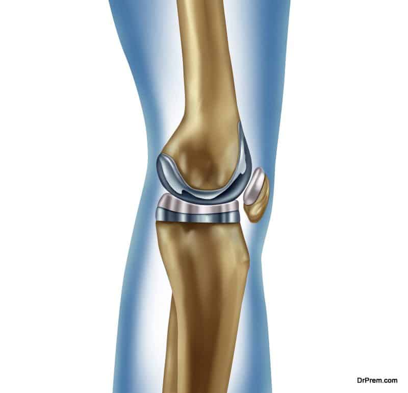 Knee-Replacement-Implant