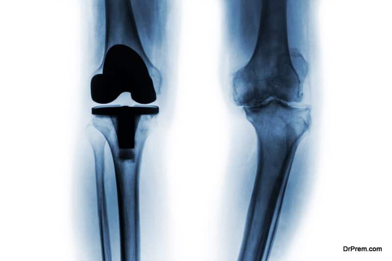 joint replacement