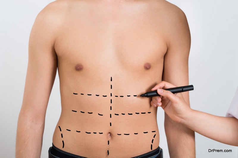 Liposuction-in-Mexico