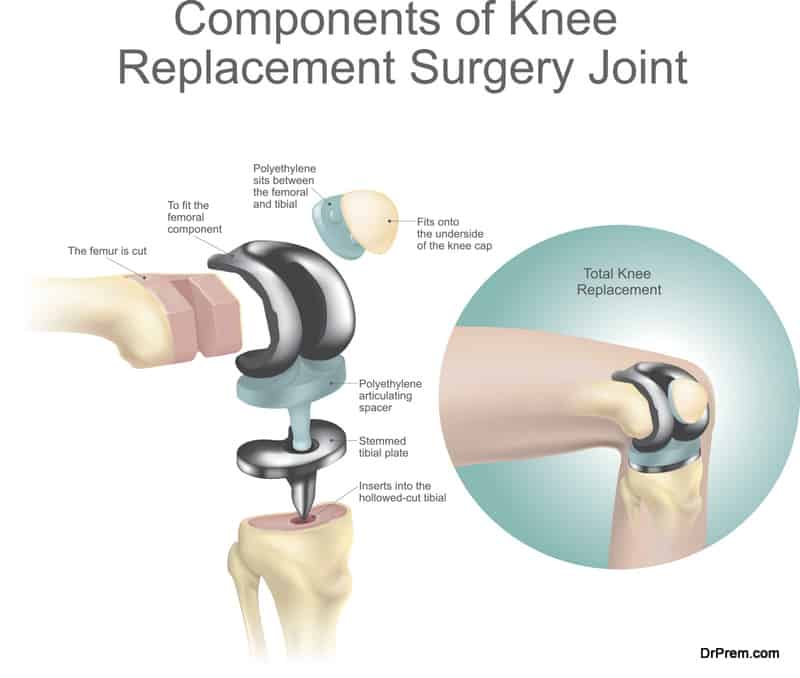 Components of knee replacement surgery joint.