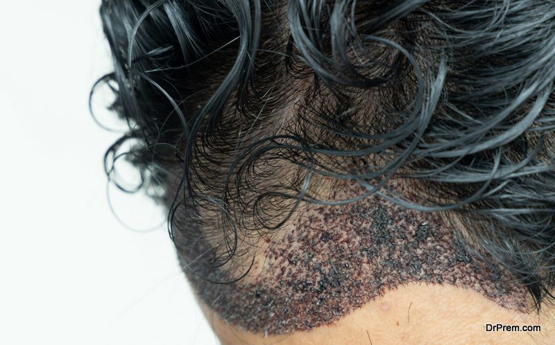 Follicular Unit Extraction treatment