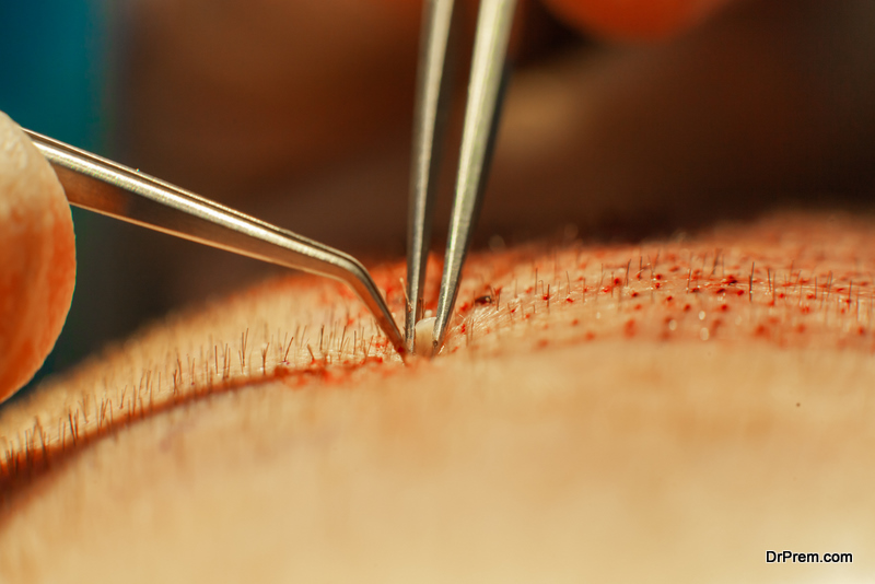 hair transplantation in Turkey