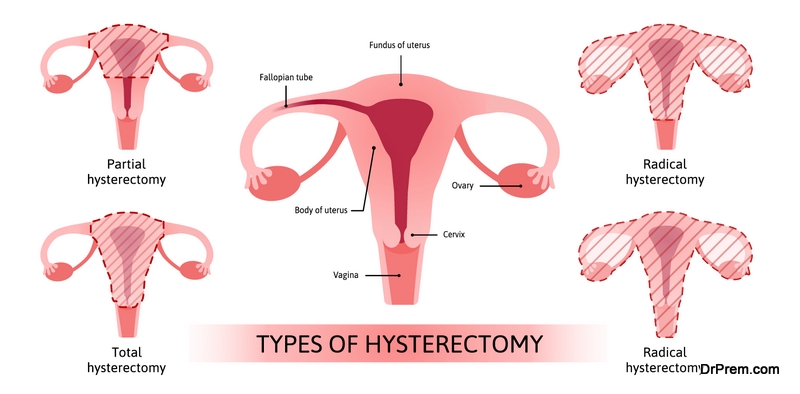 hysterectomy