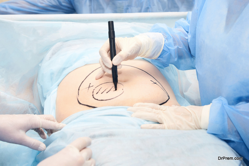 Doctor mark liposuction area at tummy