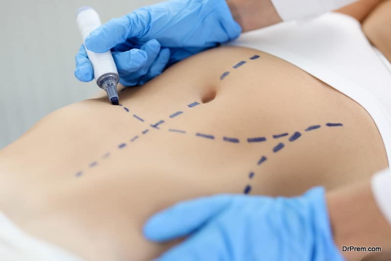 Doctor drawing preoperative marking on patient abdomen closeup. Plastic surgery liposuction concept