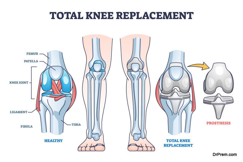 Total knee replacement surgery and prosthesis operation outline diagram
