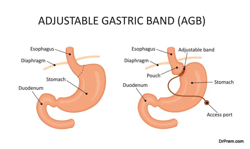 Adjustable gastric band (AGB)