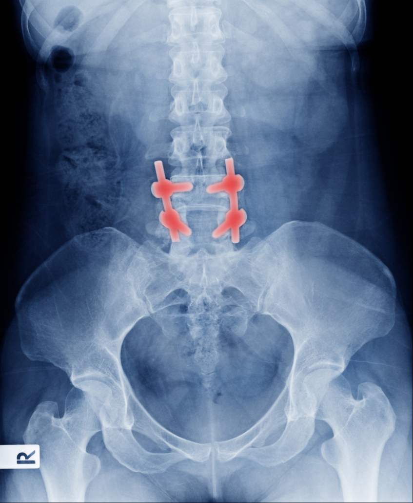 Lumbar Laminectomy – Dr Prem – Medical Tourism Facilitators And Advisor