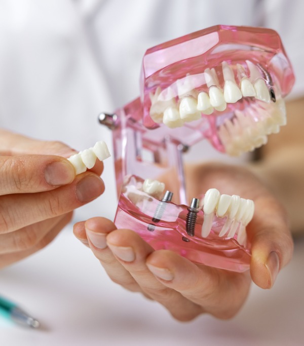 Dentist-implantologist-showing-dental-bridge-implant-technology-on-picture-id1289217040