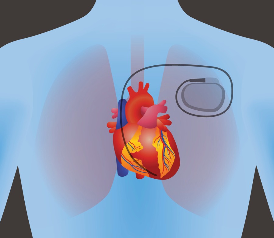 the-heart-of-human-and-artificial-cardiac-pacemaker-vector-id616893490