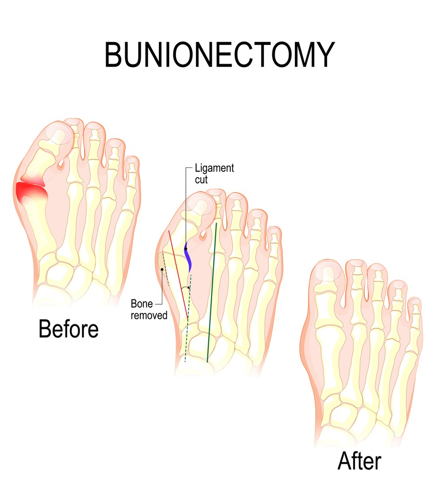 bunionectomy