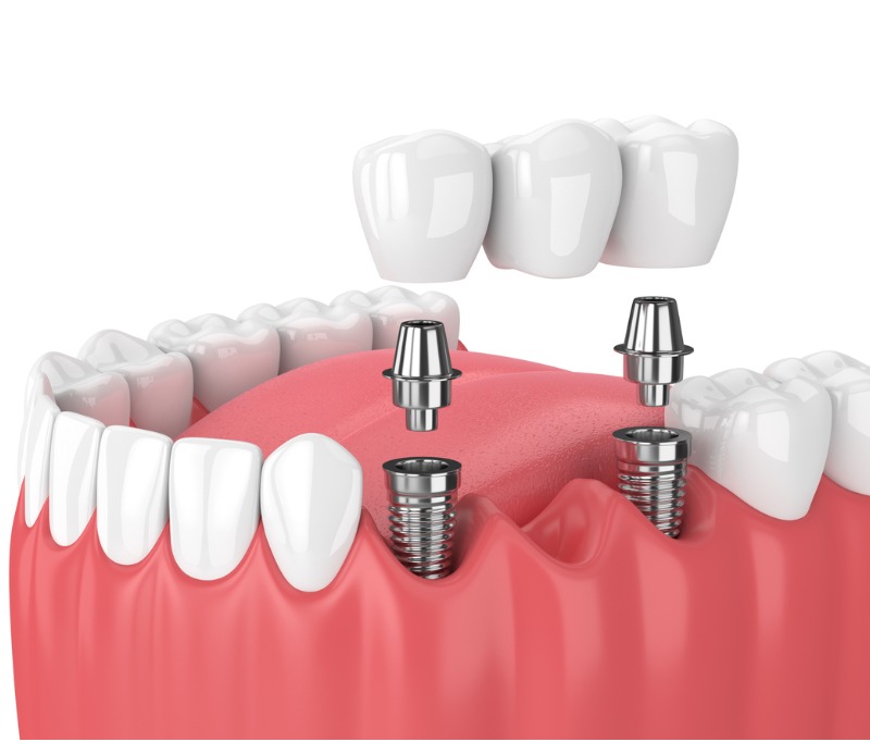 Dental Bridges