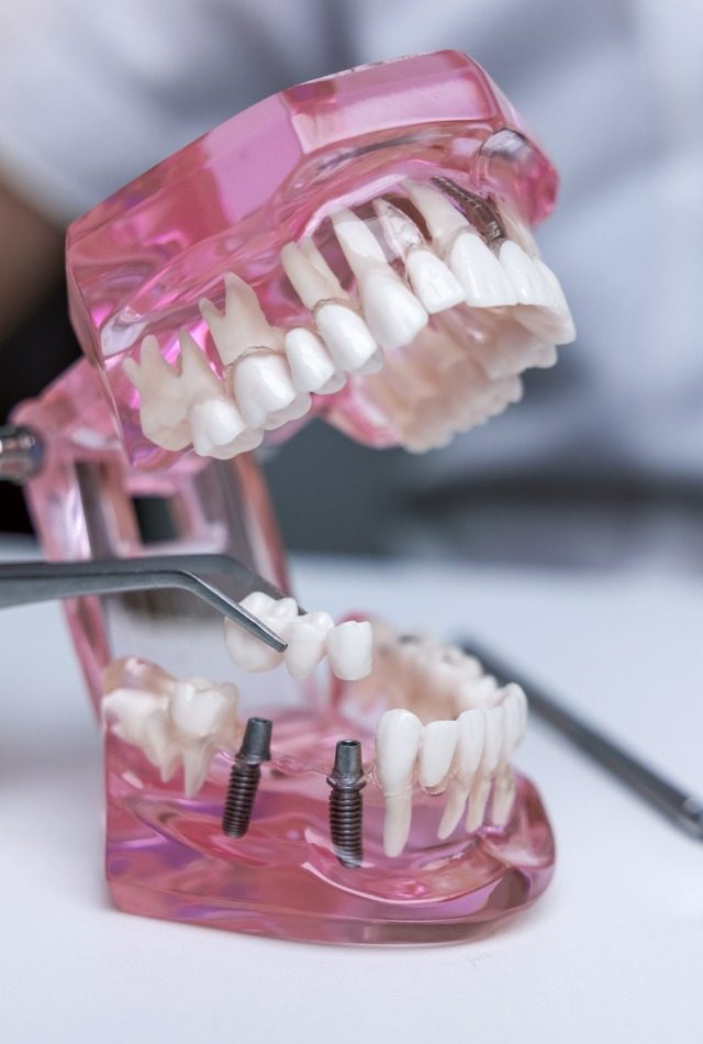 dentist-implantologist-showing-dental-bridge-implant-technology-on-picture-id1291193658