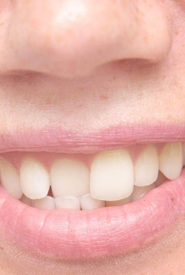 Crooked tooth correction