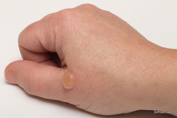 Cysts Alternative Medicine