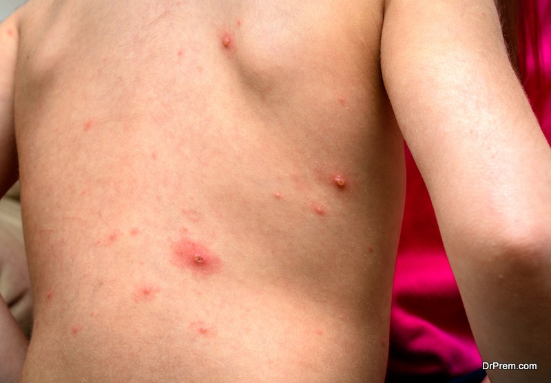 Chicken Pox Alternative Medicine 2 chicken-pox-blisters