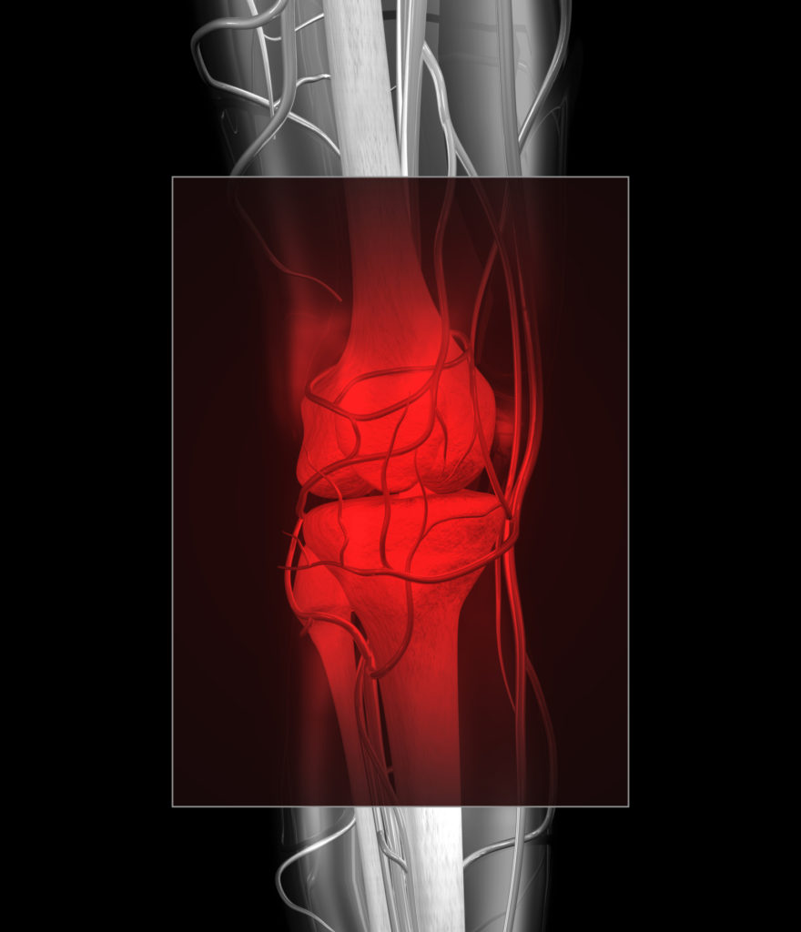 Knee Injury (XXL)