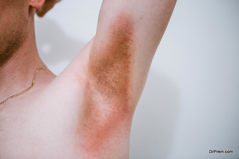  A man with a skin disease in the armpit area. Prickly heat