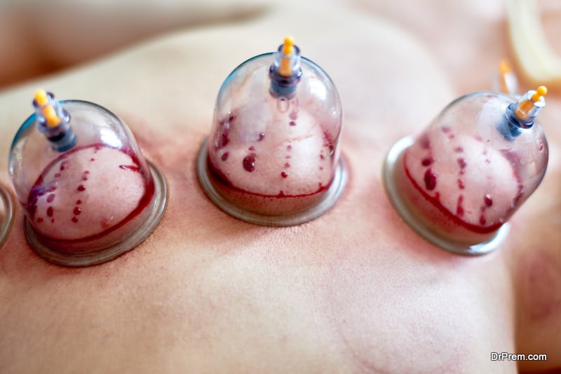 Healing bloodletting, hijama or phlebotomy. Hajam master conducts cupping therapy on a young woman. Islamic medicine