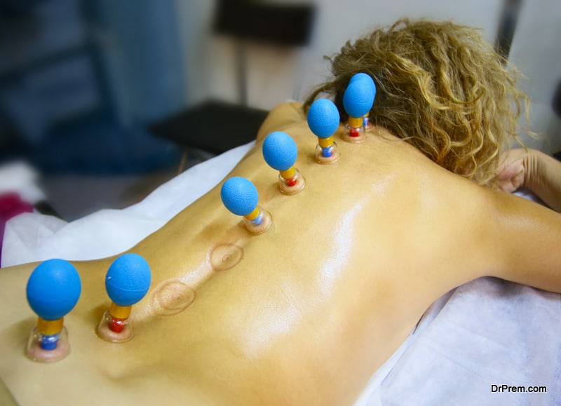 Cupping therapy. Cups from the patient's back
