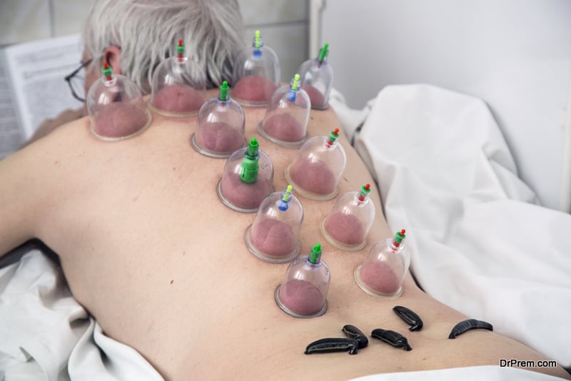 Multiple medical vacuum cupping therapy and medical leech of the human body.