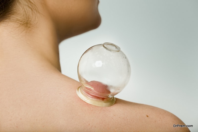 Patient receiving Chinese cupping treatment to shoulder