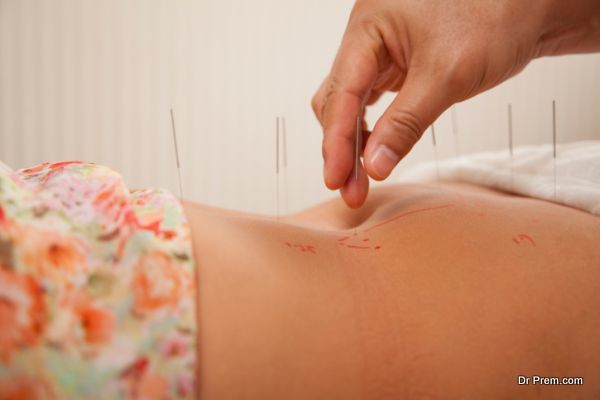 Inserting Acupuncture Needles