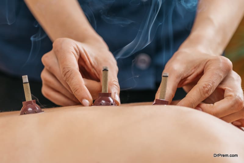 Moxibustion Therapy - Traditional Chinese Medicine. Placing burning Moxa stick on the back