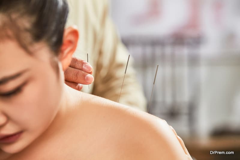 Young women shoulder acupuncture therapy