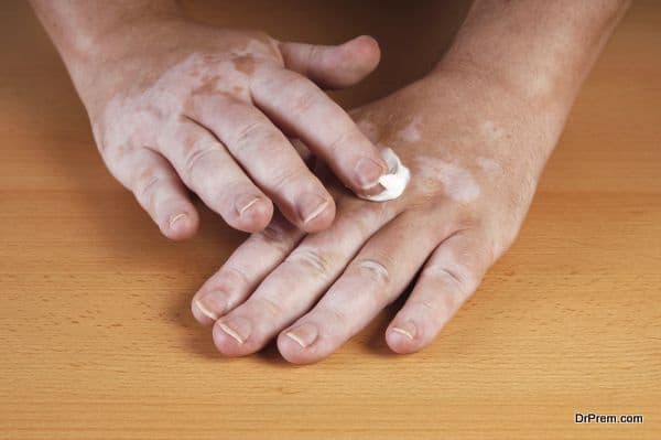 Home Treatment For Curing Vitiligo Wellness Tourism Guide