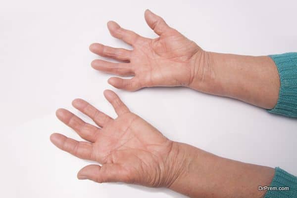 How to cure Rheumatoid Arthritis with alternative therapies