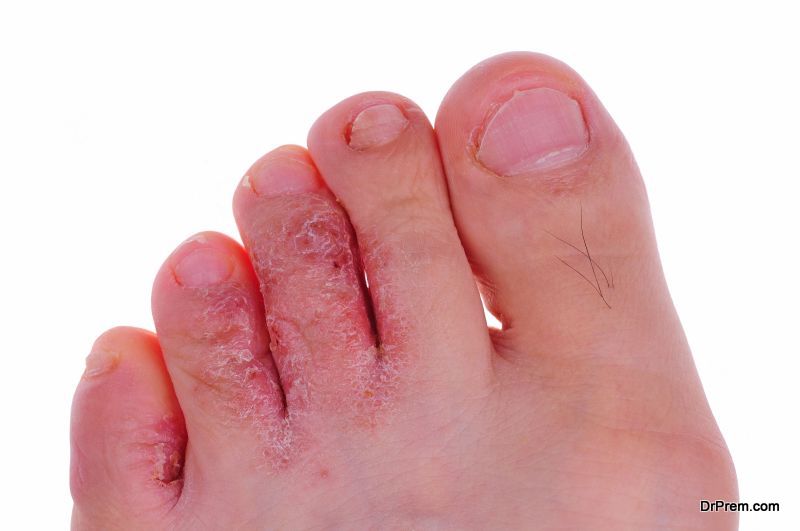 fungal infection of foot