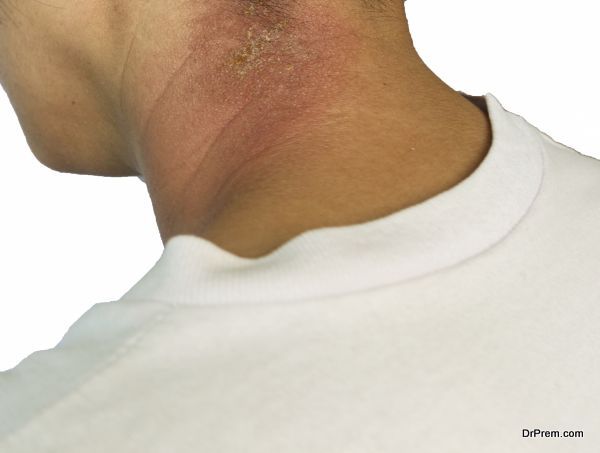 Rash on neck isolated on white background